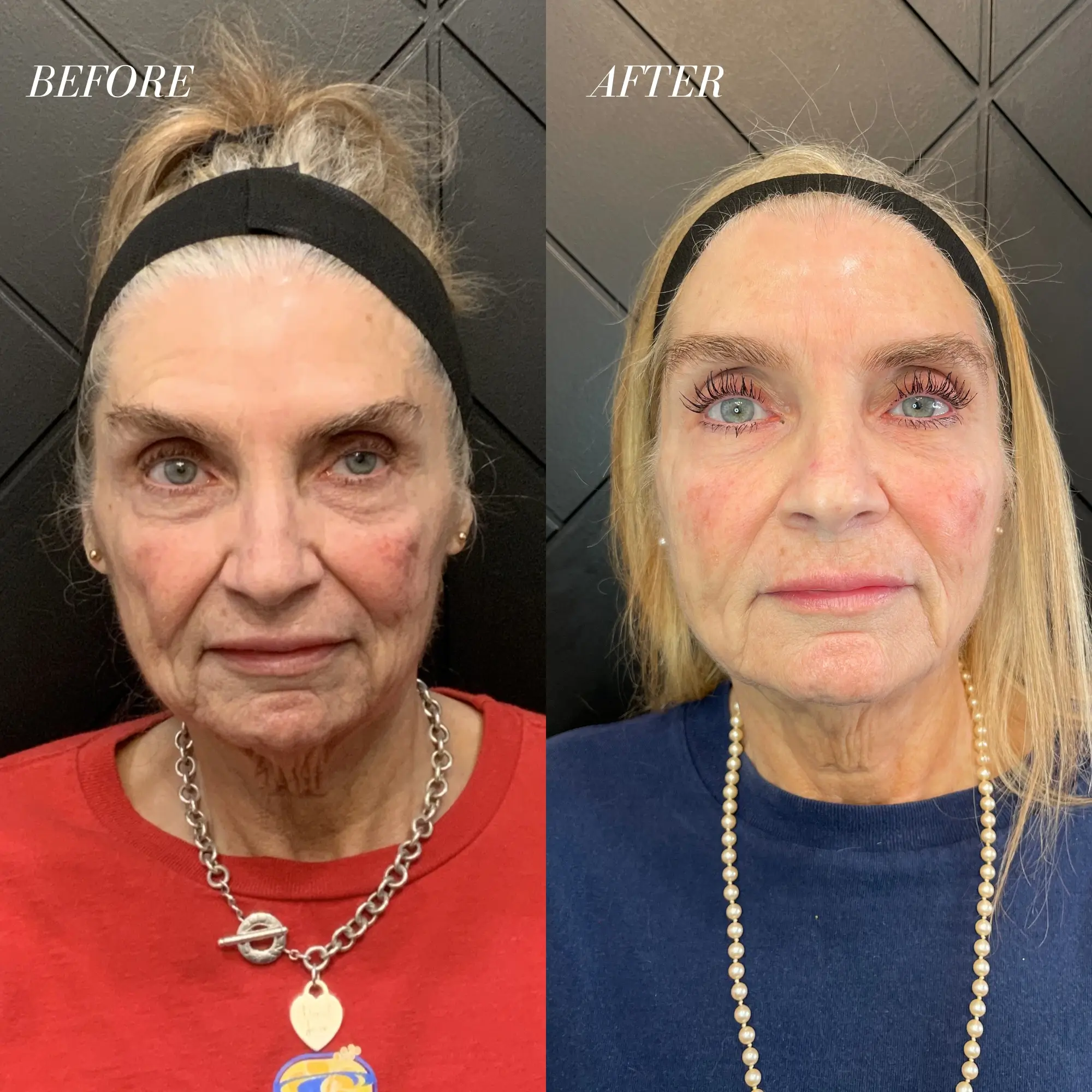 Your Dream Lips Await! See Our Lip Filler Before & After Photos