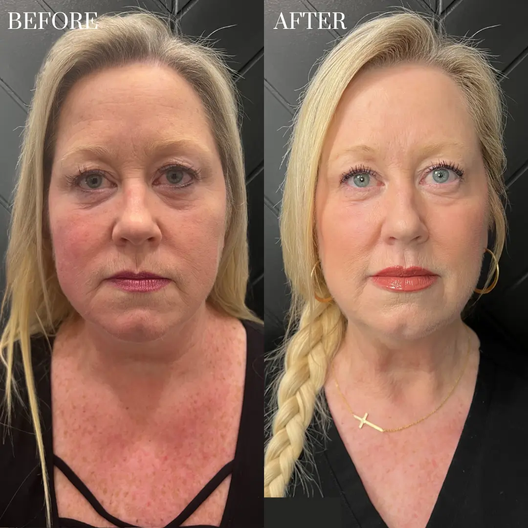 bf-a - Dermal Fillers M12