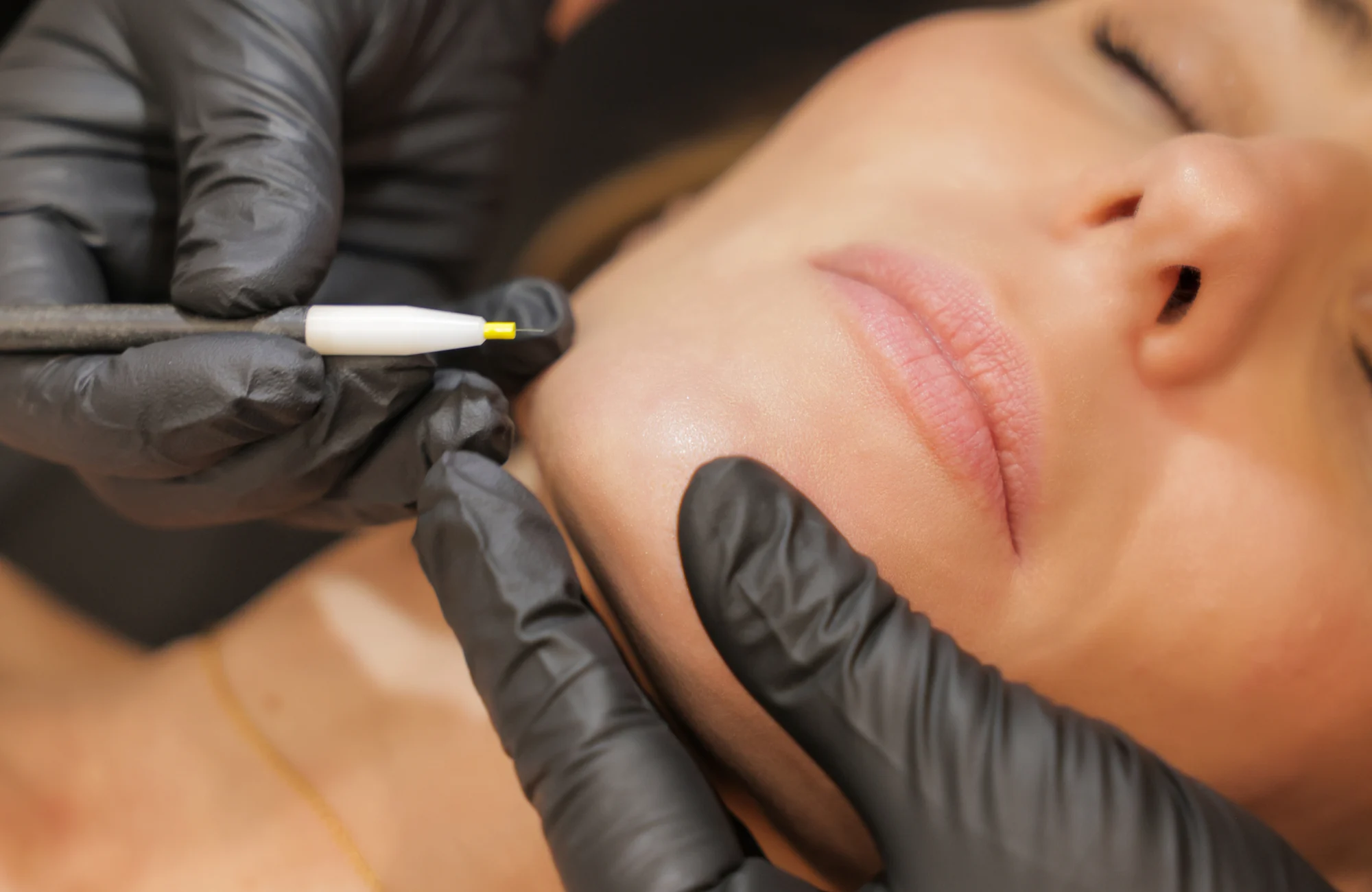 Preparing for Your First Electrolysis Session