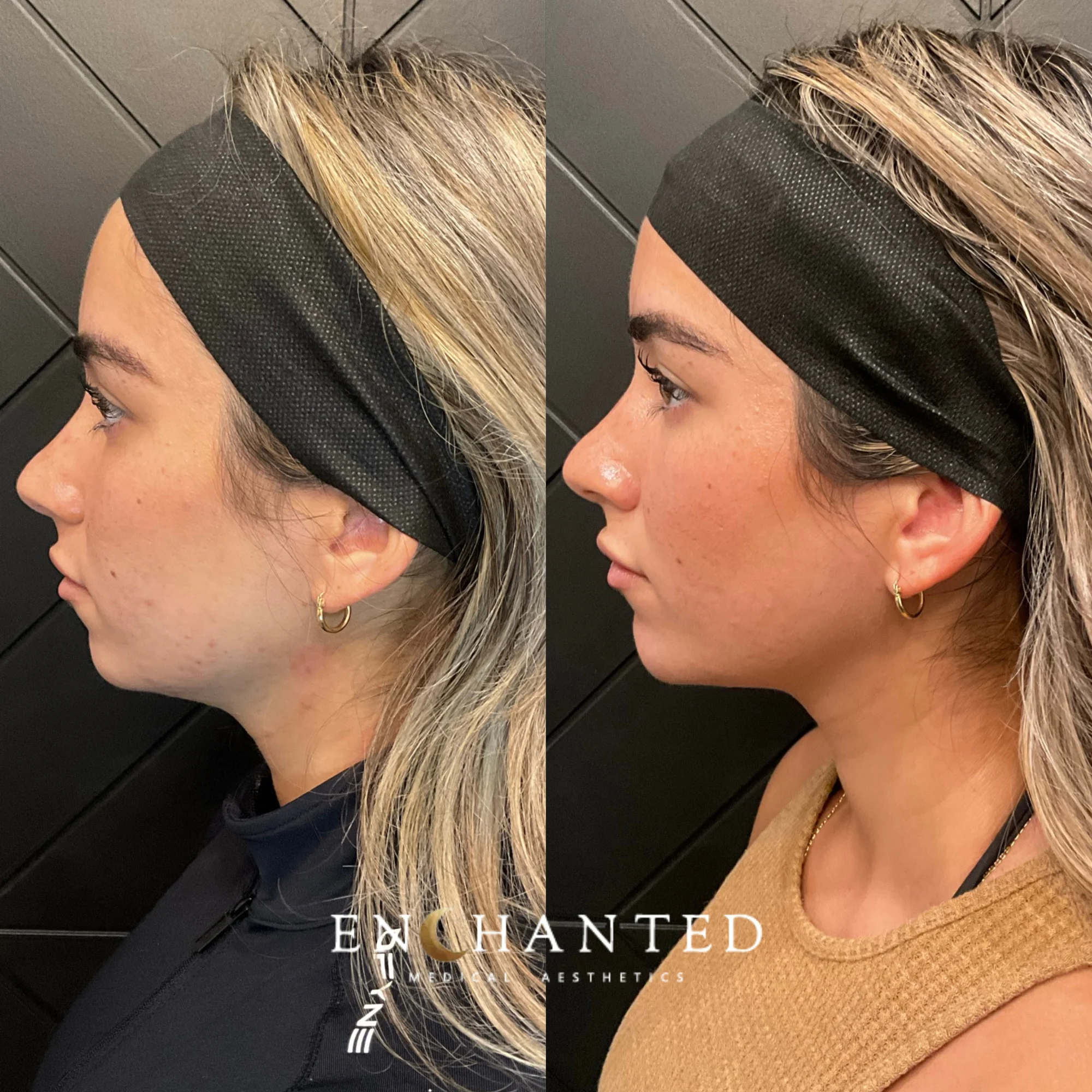 Women Before and after facial contouring Treatment