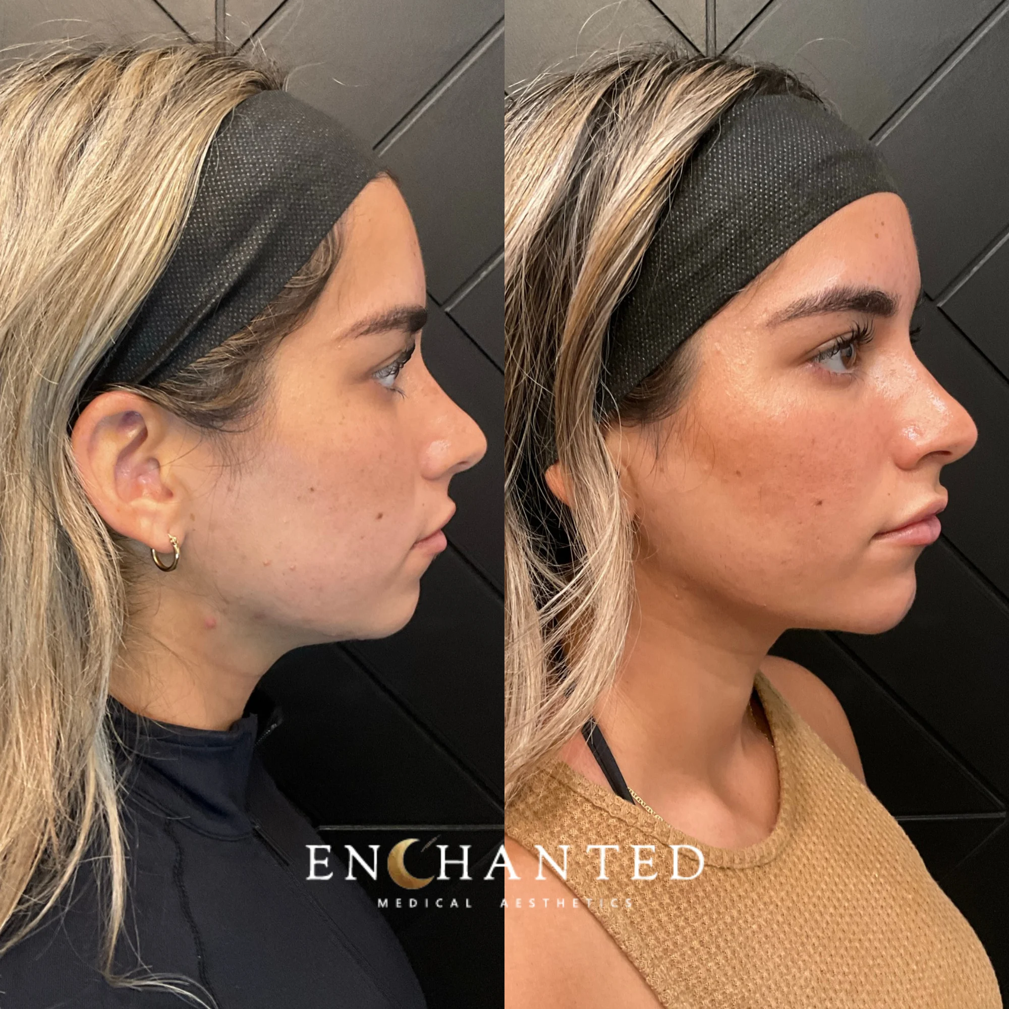 Women Facial rejuvenation before-and-after treatment
