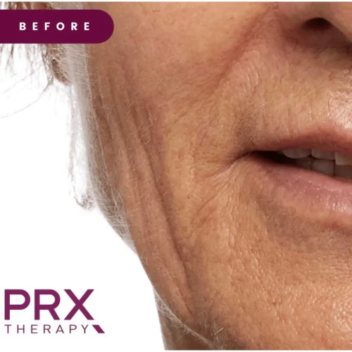 PRX Therapy