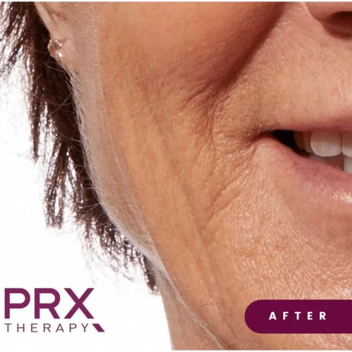 PRX Therapy